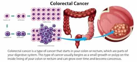 Free vector colorectal cancer with explanation