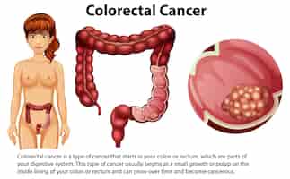Free vector colorectal cancer with explanation