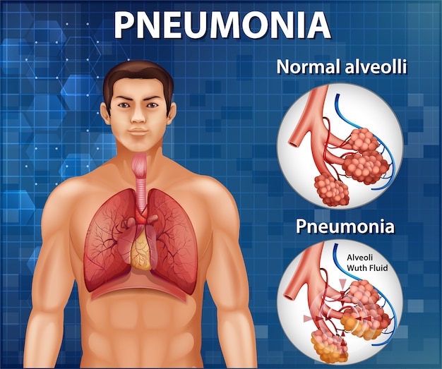 Free vector comparison of healthy alveoli and pneumonia