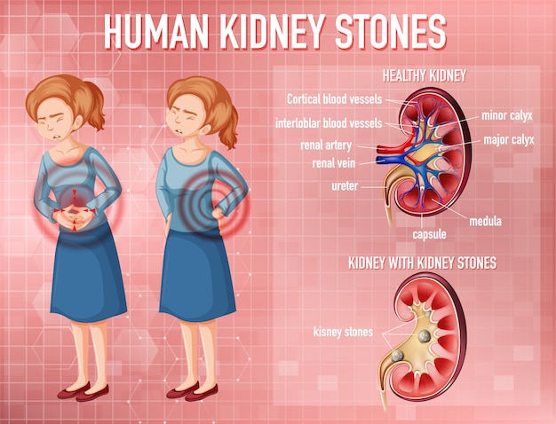 Free vector comparison of healthy kidney and kidney with stones