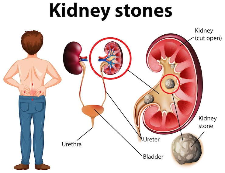 Free Vector comparison of healthy kidney and kidney with stones