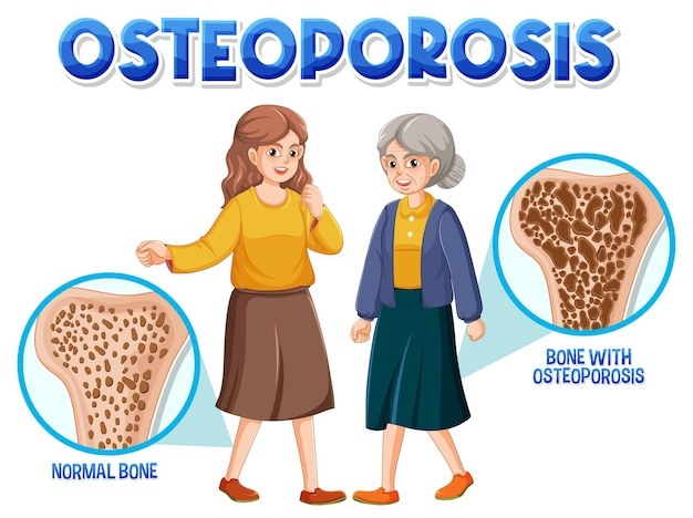 Free vector comparison of normal bone and bone with osteoporosis in old and