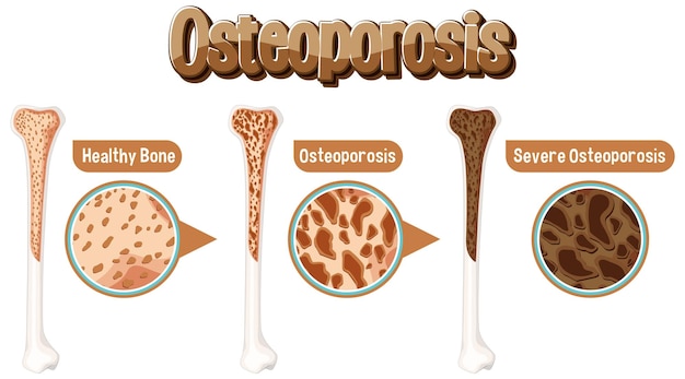 Free vector comparison of normal bone and bone with osteoporosis