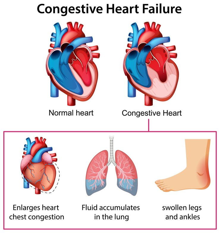 Free Vector congestive heart failure medical illustration