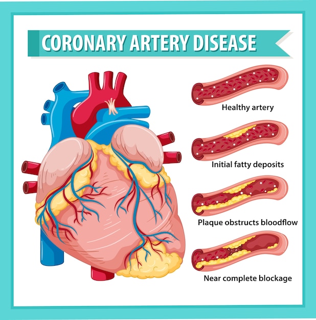 Free vector coronary artery disease for health education infographic