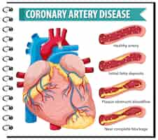 Free vector coronary artery disease for health education infographic