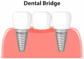 Free vector dental bridge in gum on white background