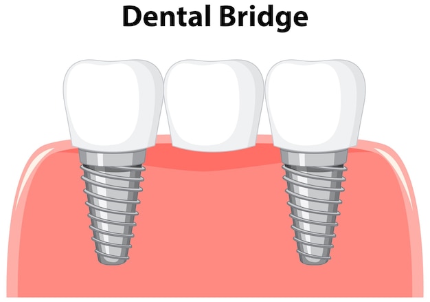 Dental bridge in gum on white background