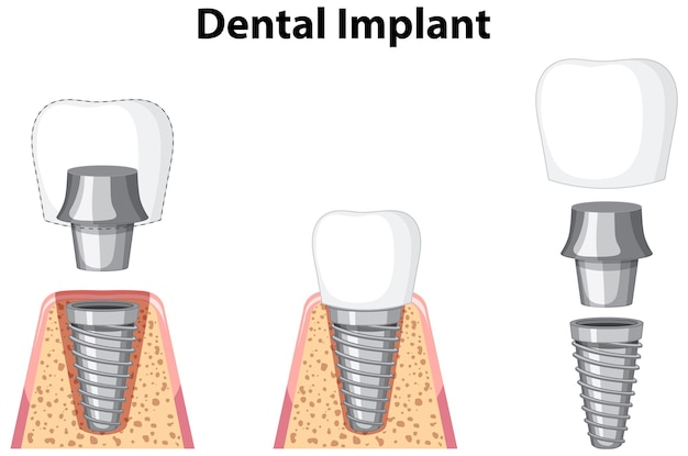 Бесплатное векторное изображение Зубной имплантат в десне на белом фоне