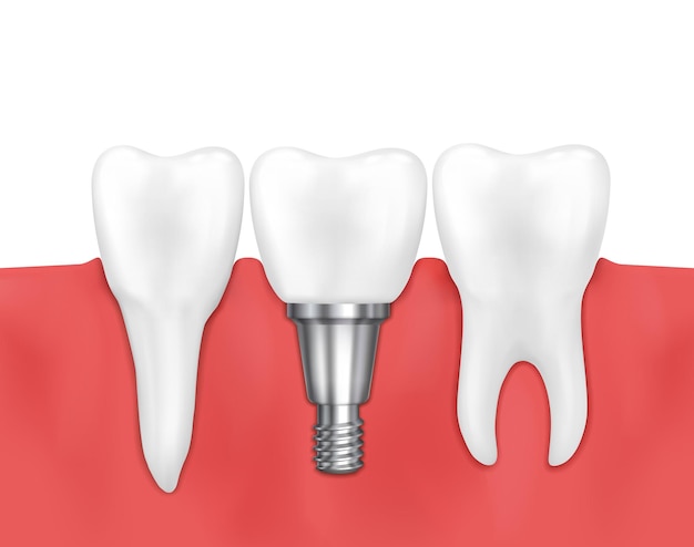 Dental implant and normal tooth  illustration