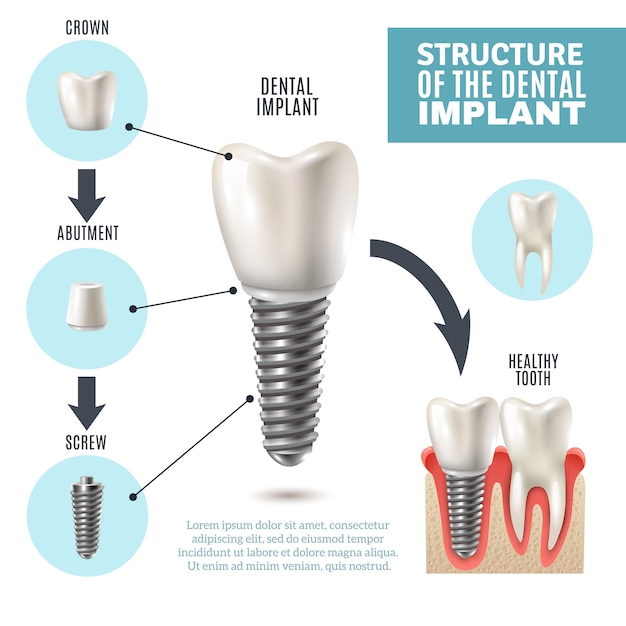 Poster di infografica medica di struttura dentale dell'impianto