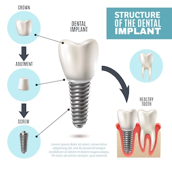 Структура зубного имплантата медицинский инфографический плакат