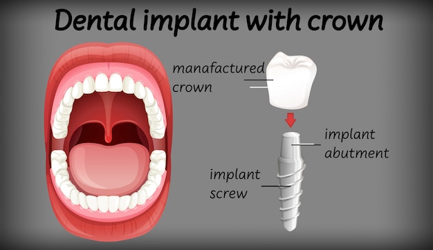 Dental implant with crown