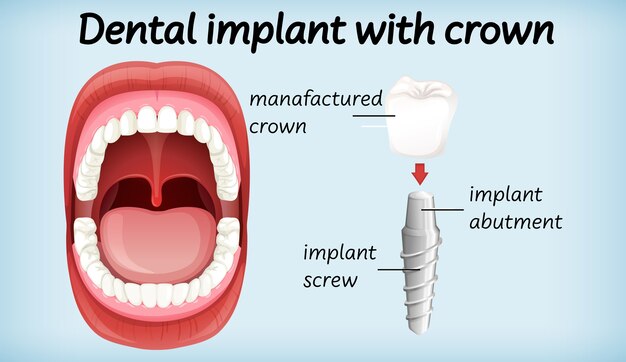 Dental implant with crown