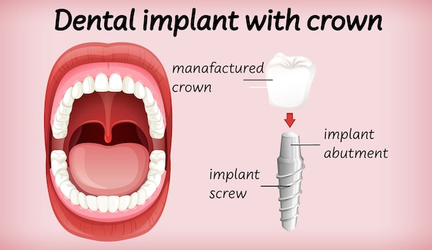 Dental implant with crown