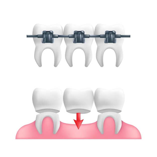 義歯の概念-固定された歯科用ブリッジワークとその上にブレースを備えた健康な歯。 Premiumベクター