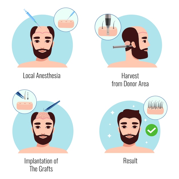 고립 된 머리 이식 절차의 단계에 수염 난된 남자와 디자인 컨셉