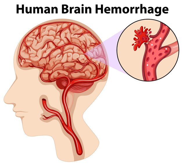 Схема кровоизлияния в мозг человека