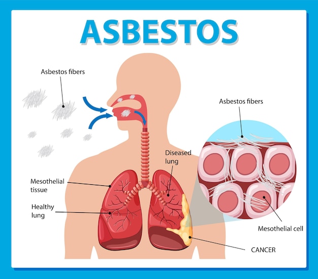 Free vector diagram showing asbestosis in lungs