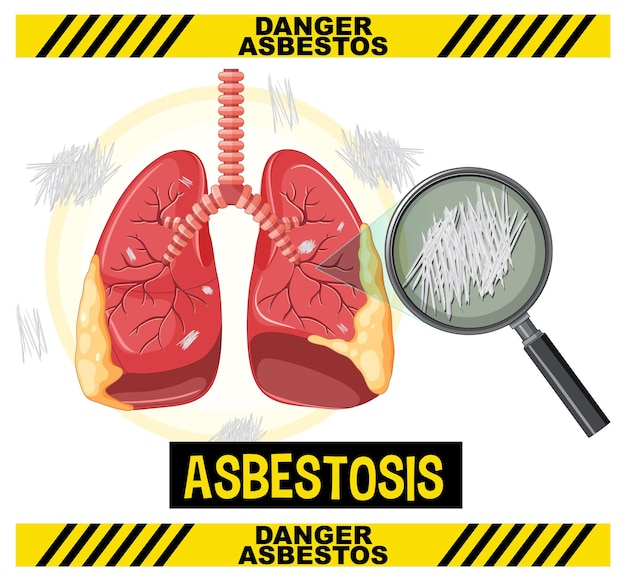 Free vector diagram showing asbestosis in lungs