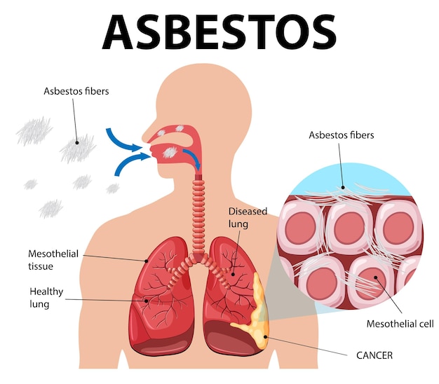 Vettore gratuito diagramma che mostra l'asbestosi nei polmoni