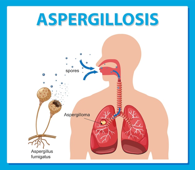 Diagram showing aspergillus infection