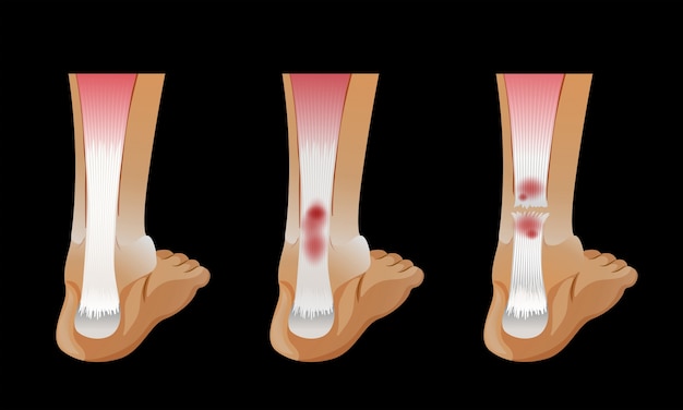 Free vector diagram showing broken bone in human foot
