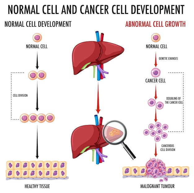 Free vector diagram showing cancer development process