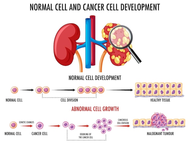 Vettore gratuito diagramma che mostra il processo di sviluppo del cancro