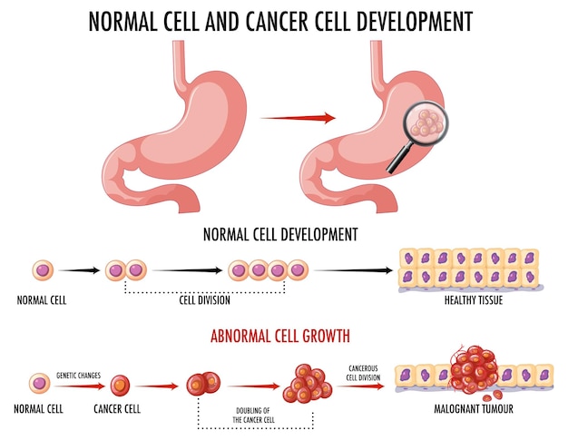 Free vector diagram showing cancer development process