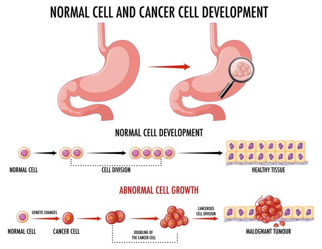 암 발달 과정을 보여주는 다이어그램