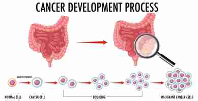 무료 벡터 암 발달 과정을 보여주는 다이어그램