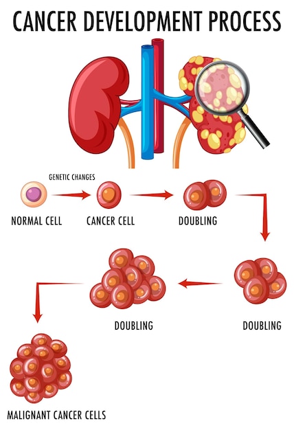 암 발달 과정을 보여주는 다이어그램