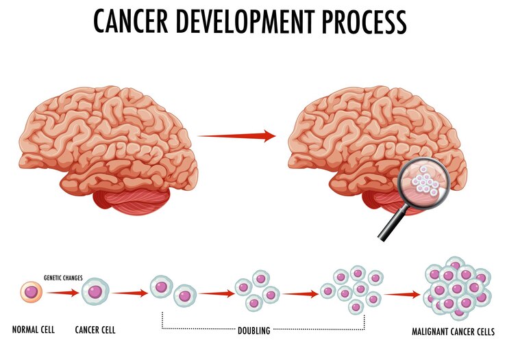 Free Vector diagram showing cancer in human brain