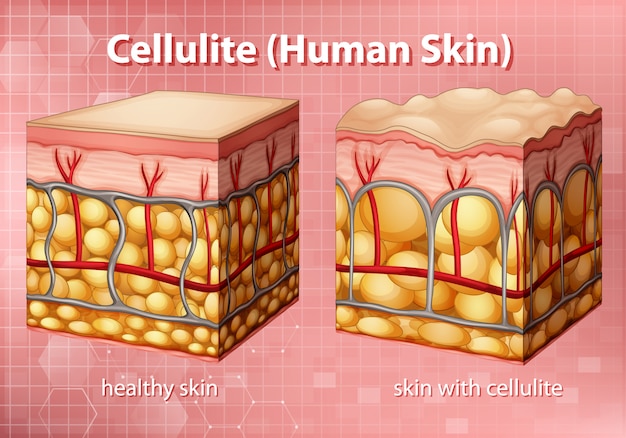 Diagram showing cellulite in human skin