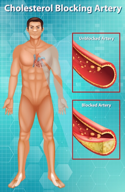 Free vector diagram showing cholesterol blocking artery in human body