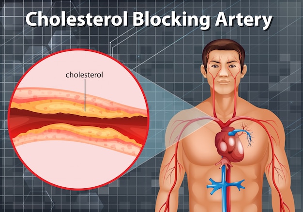 Diagram showing cholesterol blocking artery in human body