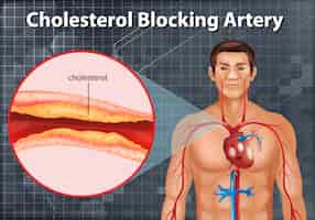 Free vector diagram showing cholesterol blocking artery in human body