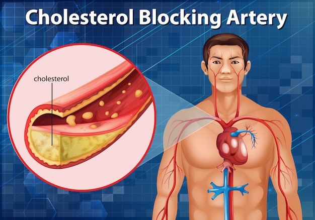 Diagram showing cholesterol blocking artery in human body