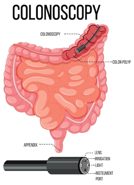 Free vector diagram showing colonoscopy in human