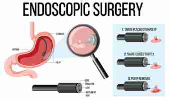 Vettore gratuito diagramma che mostra la chirurgia endoscopica