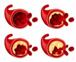 Vettore gratuito diagramma che mostra il grasso nel sangue