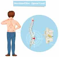 Free vector diagram showing herniated disc