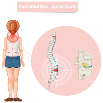 Diagram showing herniated disc