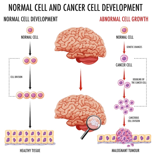 Diagramma che mostra il cervello umano e il cancro