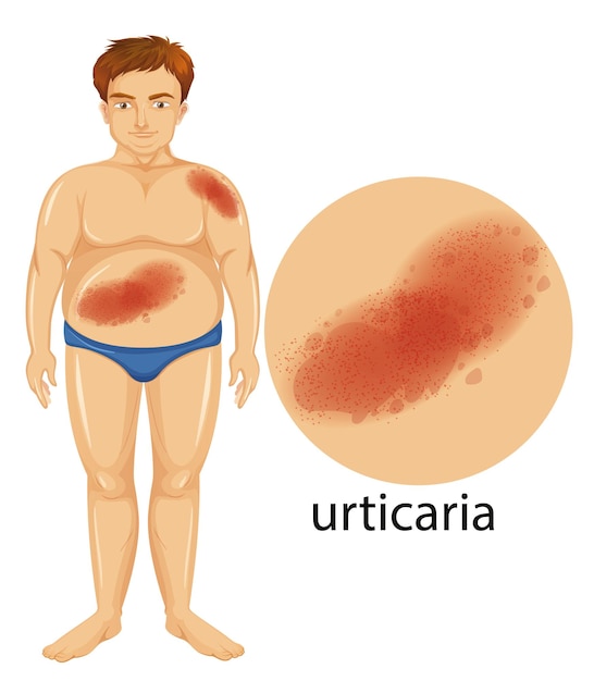 Free vector diagram showing man with urticaria