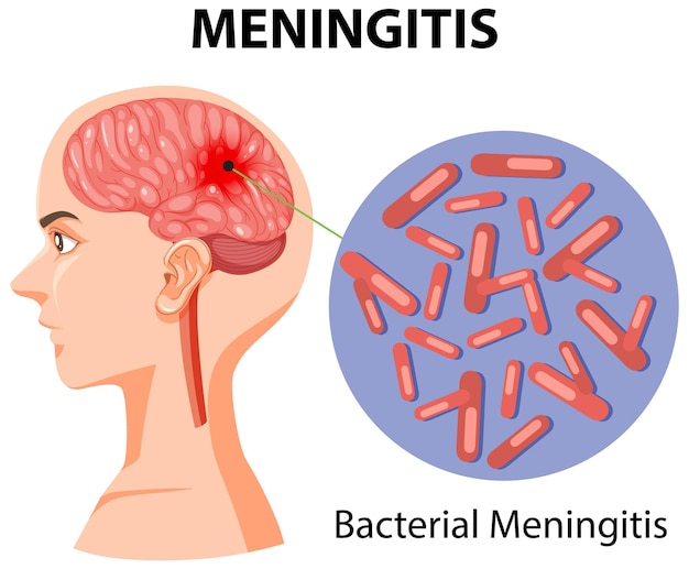 Vettore gratuito diagramma che mostra la meningite sull'uomo