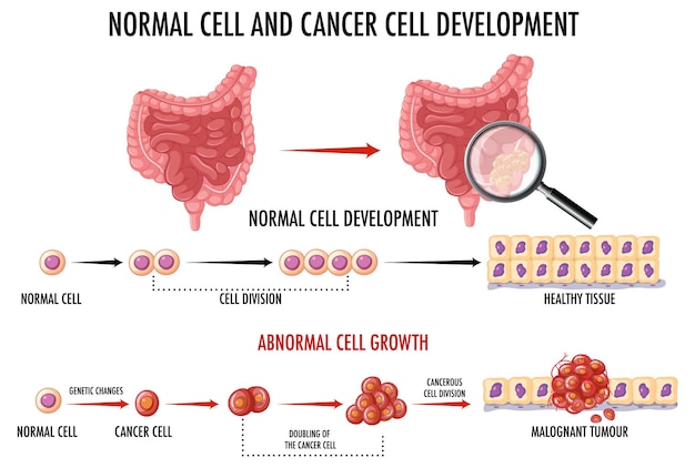 Diagramma che mostra le cellule normali e cancerose nell'uomo