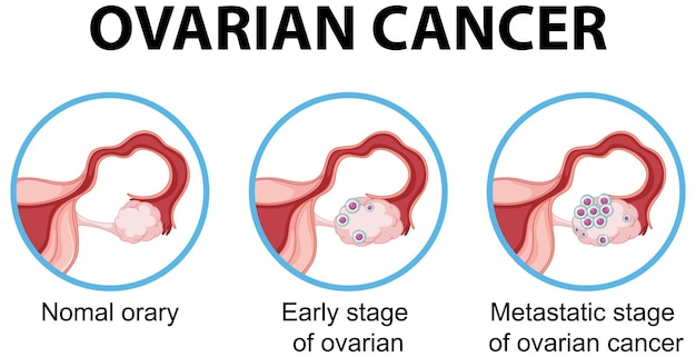 Диаграмма, показывающая рак яичников у человека