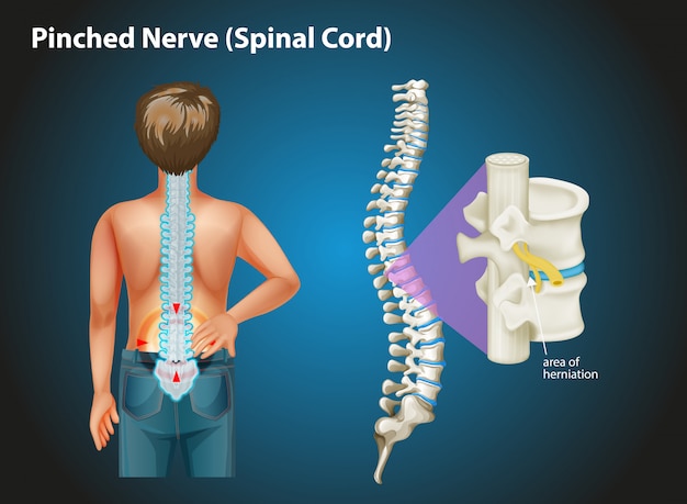 Free vector diagram showing pinched nerve in human